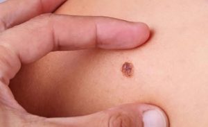 5 triệu chứng cảnh báo ung thư giai đoạn sớm bạn tuyệt đối không nên bỏ qua
