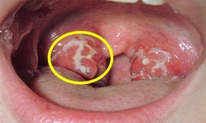 Cảnh báo: Khi thấy cơ thể có dấu hiệu này phải tới bệnh viện ngay kẻo UT vòm họng giai đoạn cuối