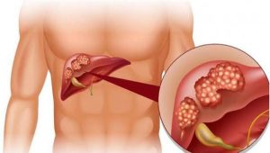 Những tín hiệu nhỏ báo bệnh gan, chớ chủ quan